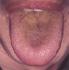 Lengua amarilla. Significado en la Medicina China